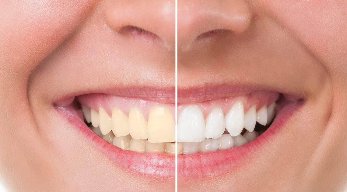 teeth-whitening-cleveland